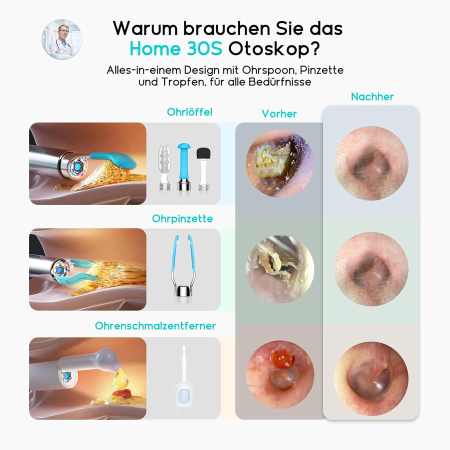 Otoscope BEBIRD Home 30S - Kit Complet de Nettoyage des Oreilles avec Caméra Flexible Pour Adultes & Enfants